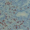 Immunohistochemistry study showing human herpes virus type 8 (HHV-8)