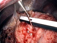 Laparoscopic ultrasonography-guided core needle biopsy