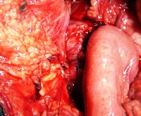 Proximal pancreas and jejunal Roux-en-Y pancreaticojejunostomy