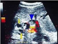Transverse power Doppler scan