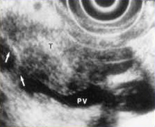 Diagnosis of portal vein invasion with EUS