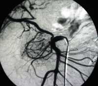 Example of vascular acrade