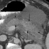 Edematous acute pancreatitis