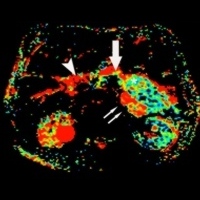 Apparent diffusion coefficient-maps